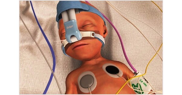 Dräger and VirtualiSurg receive Obsidian Award for Babyleo XR extended reality simulator.