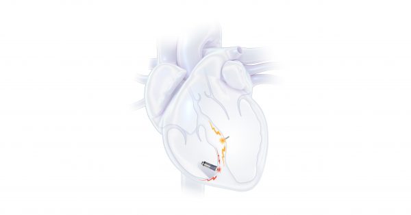 First Commercial Implants of WiSE System for CRT patients